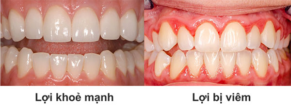 Viêm Lợi Là Gì Dấu Hiệu Nhận Biết Và Cách Điều Trị