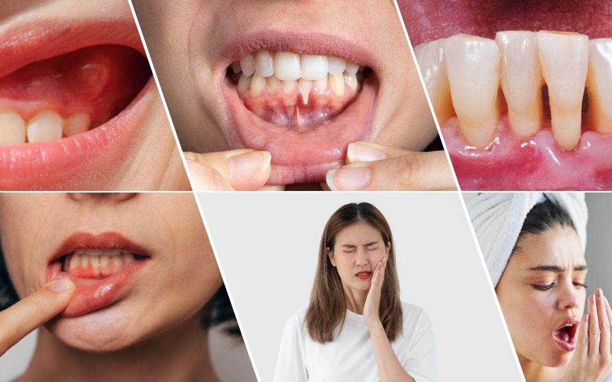Viêm Nướu Là Gì Dấu Hiệu, Nguyên Nhân Và Cách Điều Trị