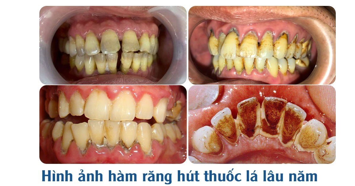 Viêm Nướu Là Gì Dấu Hiệu, Nguyên Nhân Và Cách Điều Trị